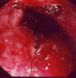 薬剤性大腸炎の大腸内視鏡