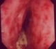 細菌性大腸炎の大腸内視鏡