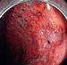 虚血性大腸炎の大腸内視鏡