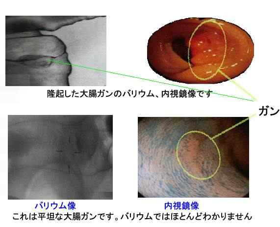 大腸内視鏡と大腸レントゲンの比較